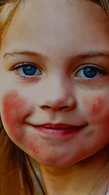 Dermatitis Atópica en niños