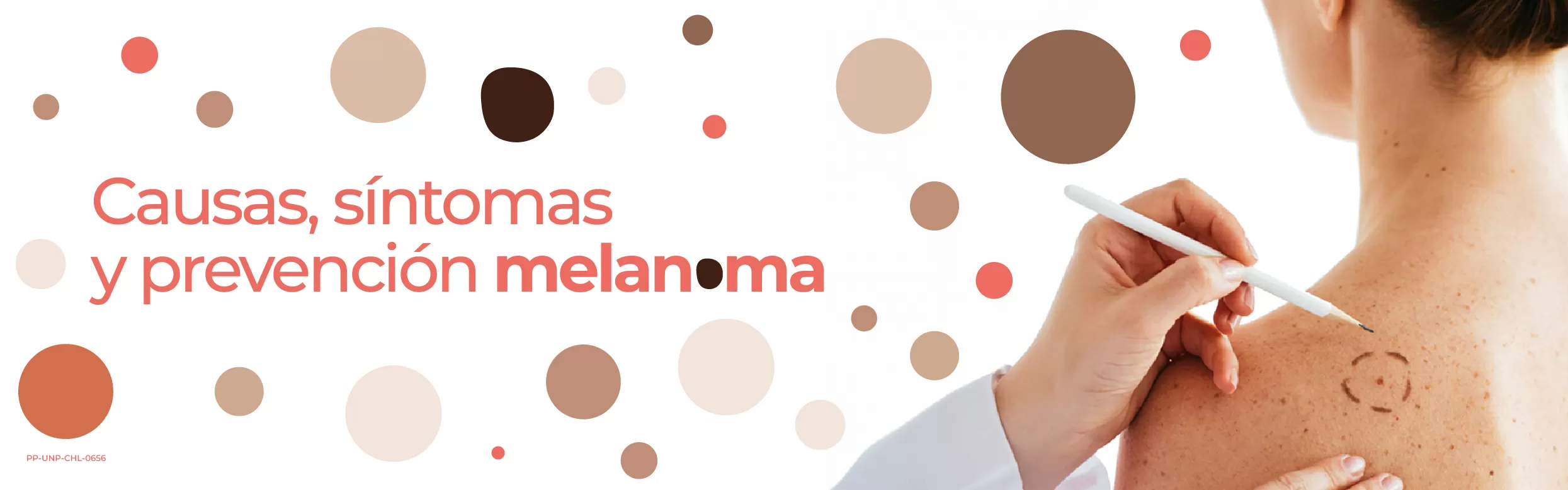 Melanoma: causas, síntomas y prevención