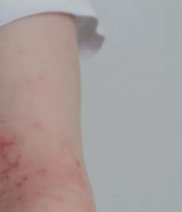 Guía práctica para entender la Dermatitis Atópica