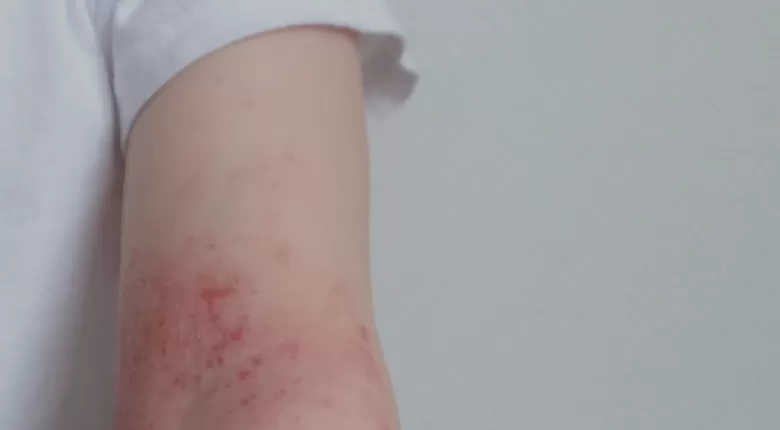 Guía práctica para entender la Dermatitis Atópica